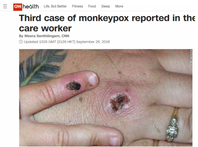 Screenshot 8 მაიმუნის ყვავილზე CNN-ის და New York Post-ის სტატიების სქრინშოტები მანიპულაციურად ვრცელდება
